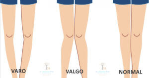 Valgo Varo