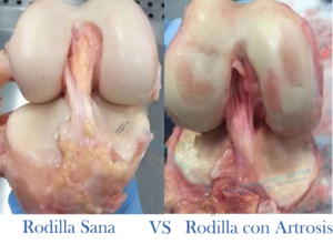 comparativa rodilla